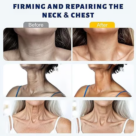 Neck and chest before after comparison