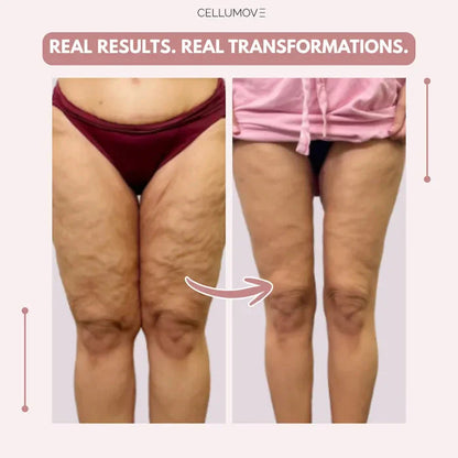 Rusticorbit 3D legging - say goodbye to lipedema pain and swelling naturally