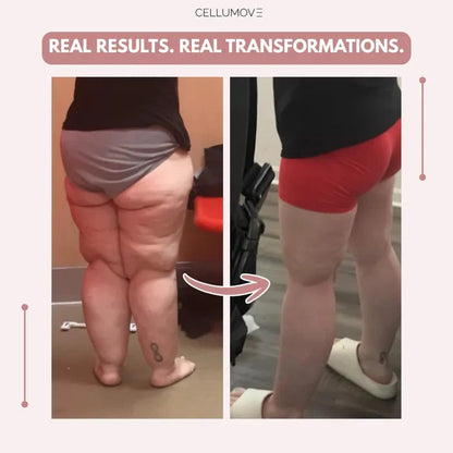 Rusticorbit 3D legging - say goodbye to lipedema pain and swelling naturally