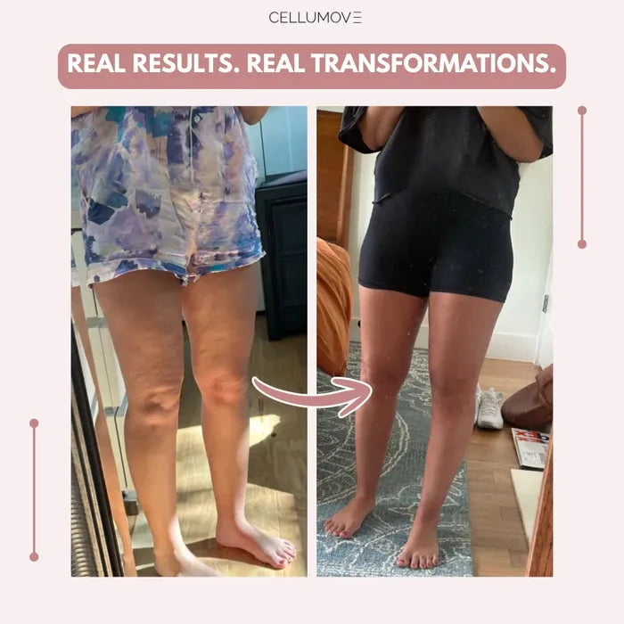 Rusticorbit 3D legging - say goodbye to lipedema pain and swelling naturally