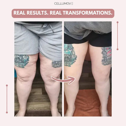 Rusticorbit 3D legging - say goodbye to lipedema pain and swelling naturally