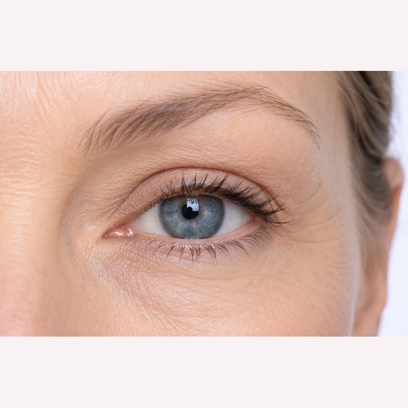 Illustrative after view: more defined upper eyelid crease